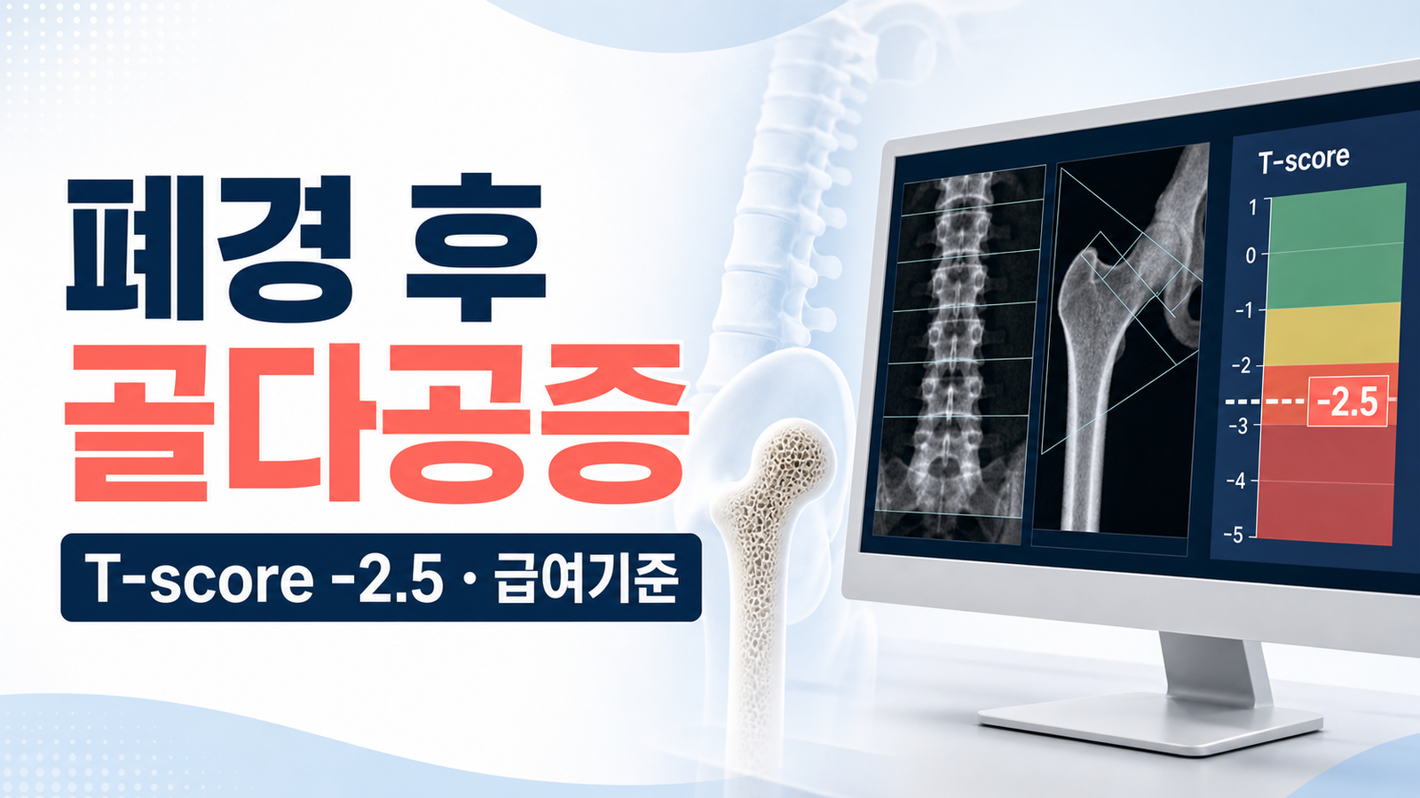 폐경 후 골다공증 T-score -2.5와 급여기준을 설명하는 썸네일