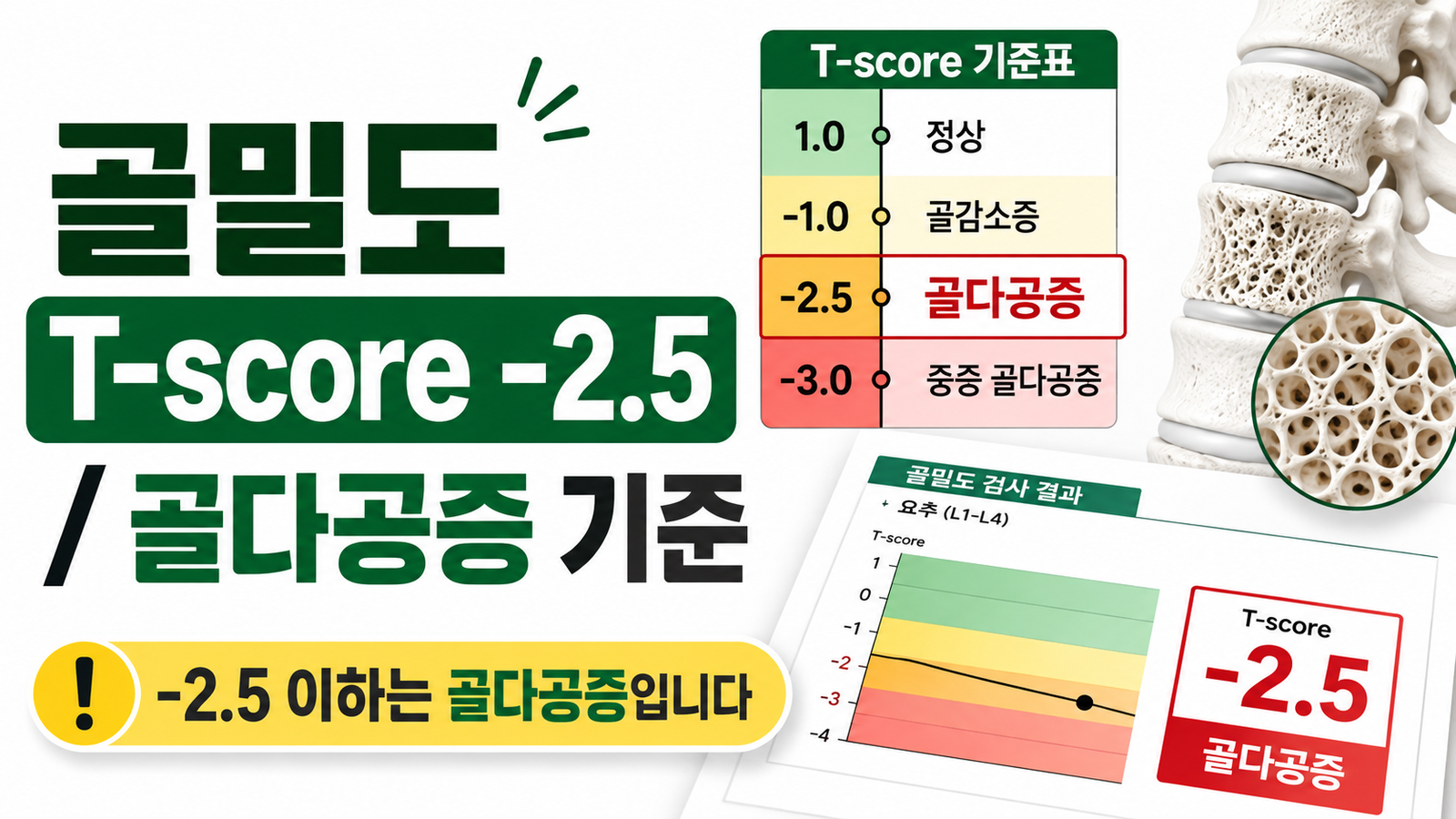 골밀도 T-score -2.5, 골다공증 진단과 건강보험 치료 기준 핵심 기준과 확인 절차 썸네일